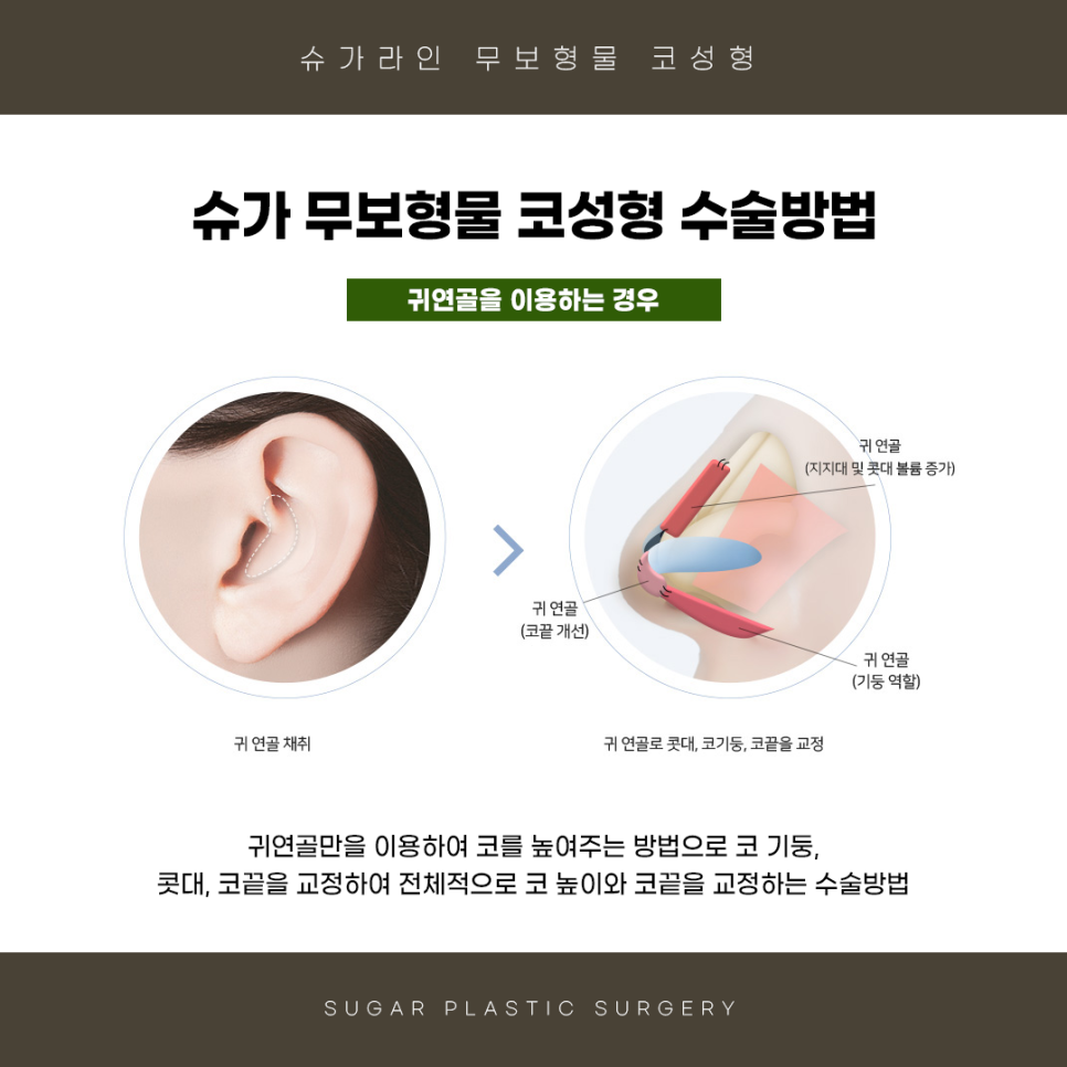 무보형물 코수술 슈가성형외과 관련 이미지 4
