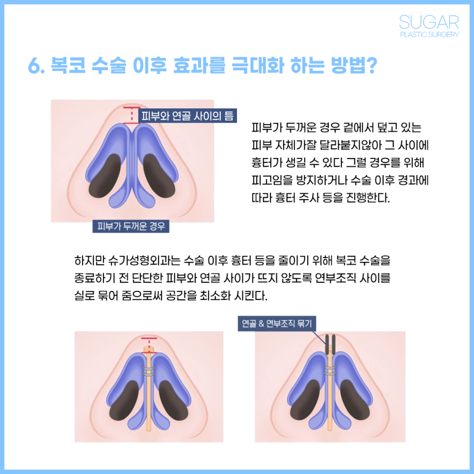 복코수술 유형에 따른 수술방법 관련 이미지 5