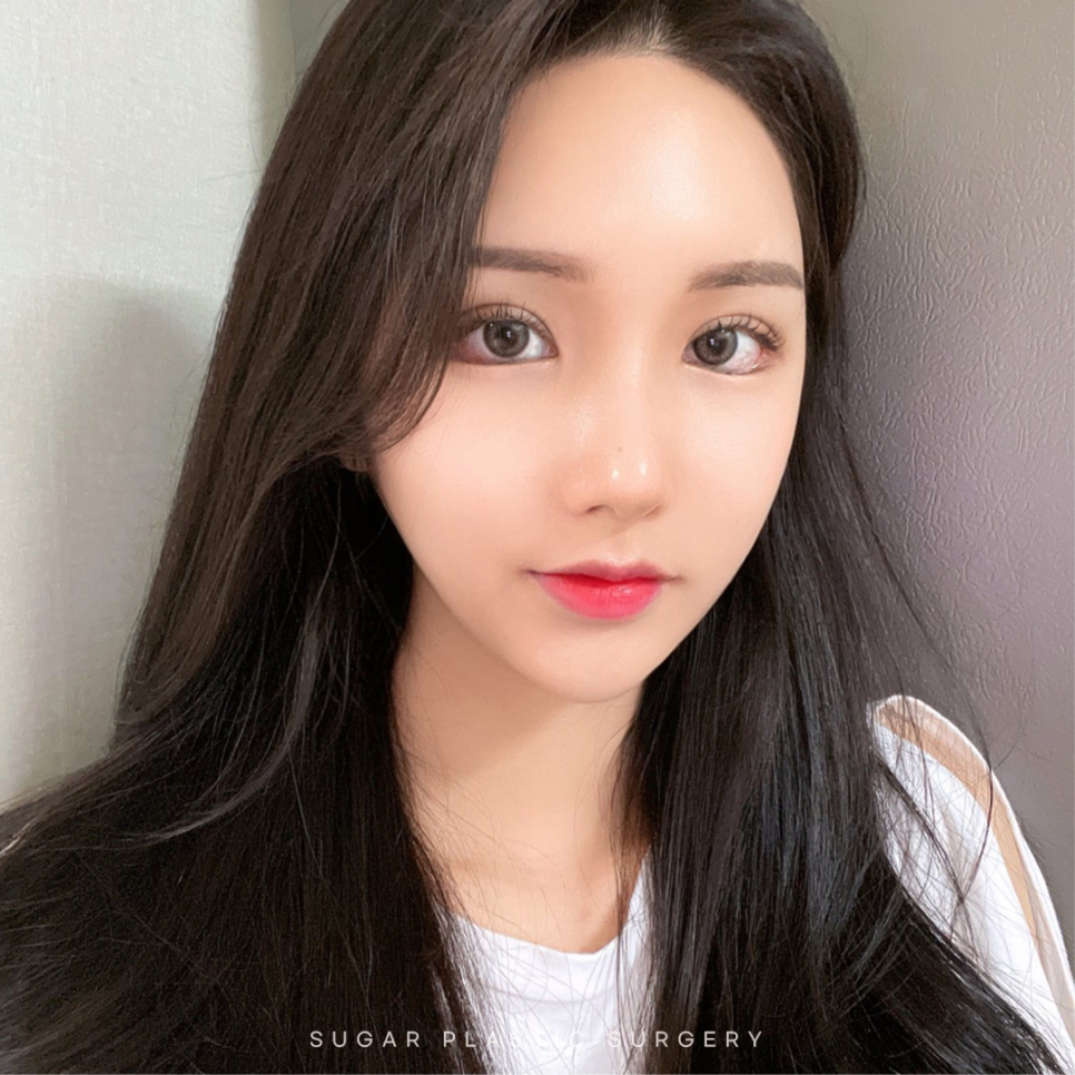 라인높이기 눈재수술 이것만은 알고가자 관련 이미지 2