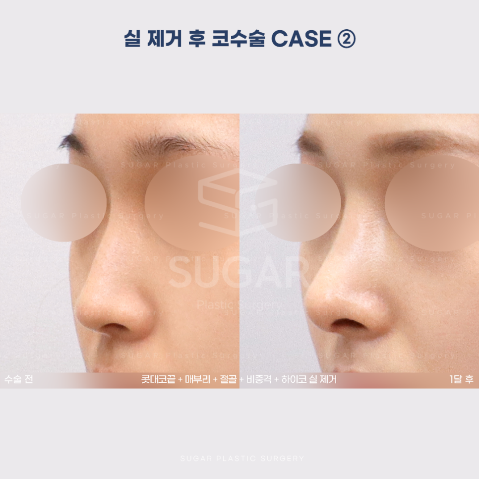[슈가성형외과] 이런 코시술 하지마세요 관련 이미지 10