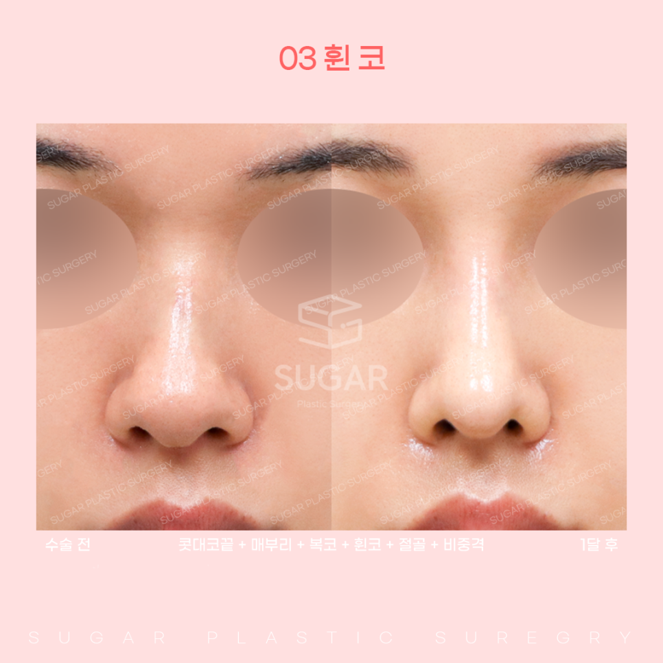 코 유형에 따른 코성형 방법 관련 이미지 13