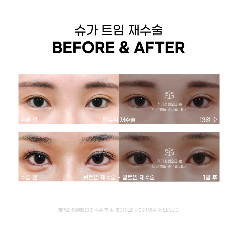 트임재수술 실패없이 하려면 관련 이미지 5