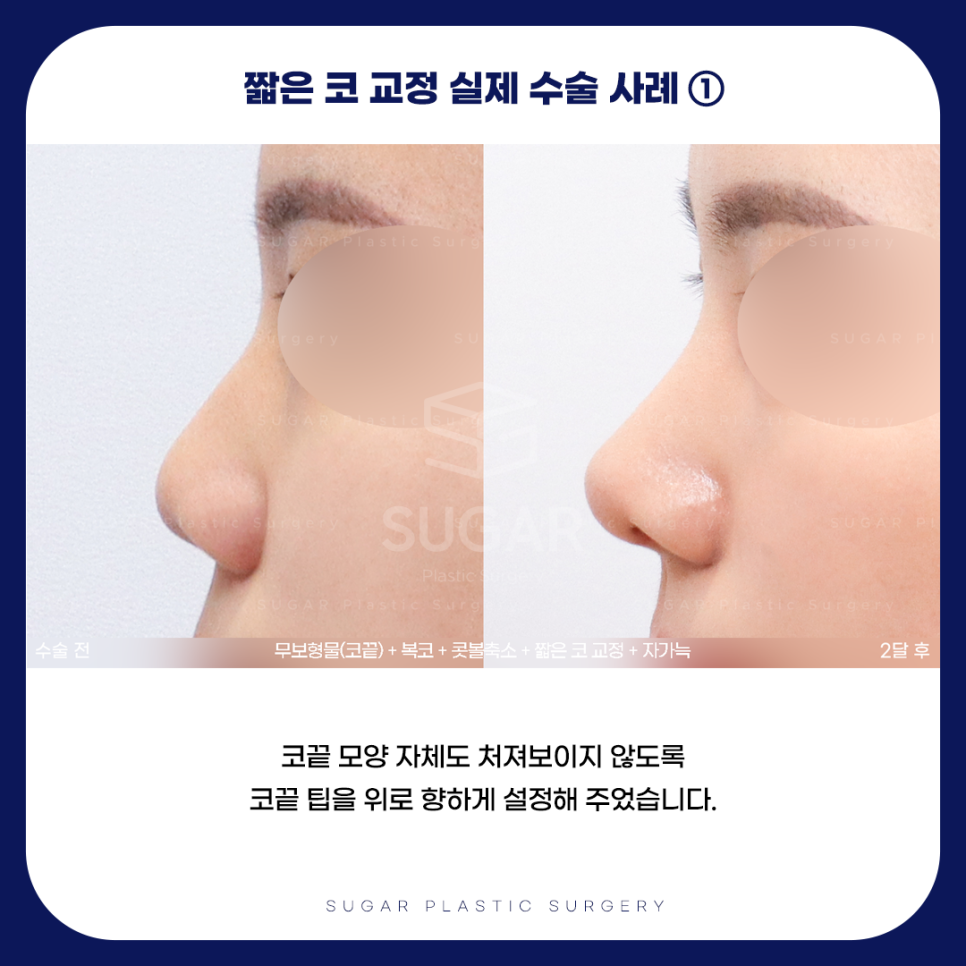 긴코 VS 짧은코 관련 이미지 14