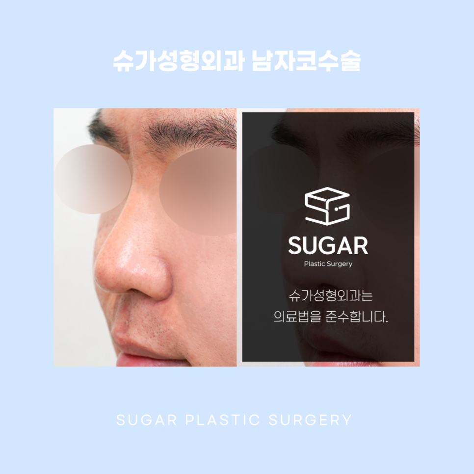 남자코수술 여자랑 어떻게 다를까 관련 이미지 2