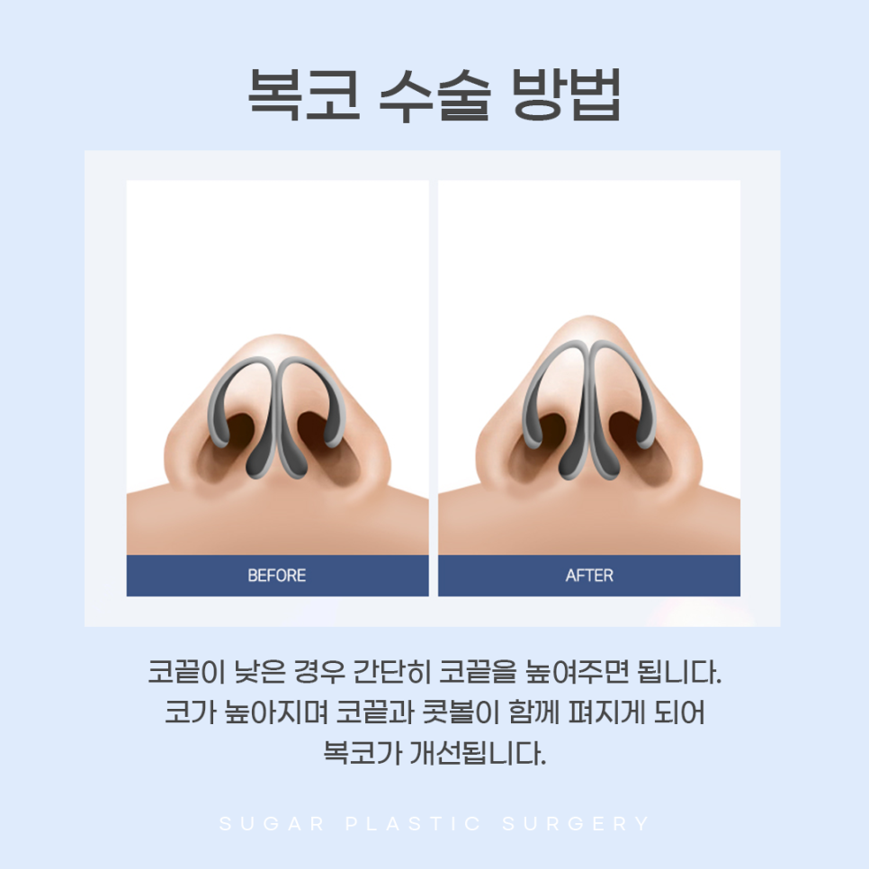 콧볼축소와 코끝성형을 같이 하는 이유는? 관련 이미지 8