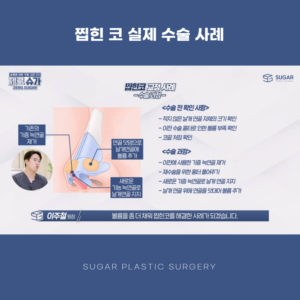 찝힌코 왜 생기는 걸까? 관련 이미지 10