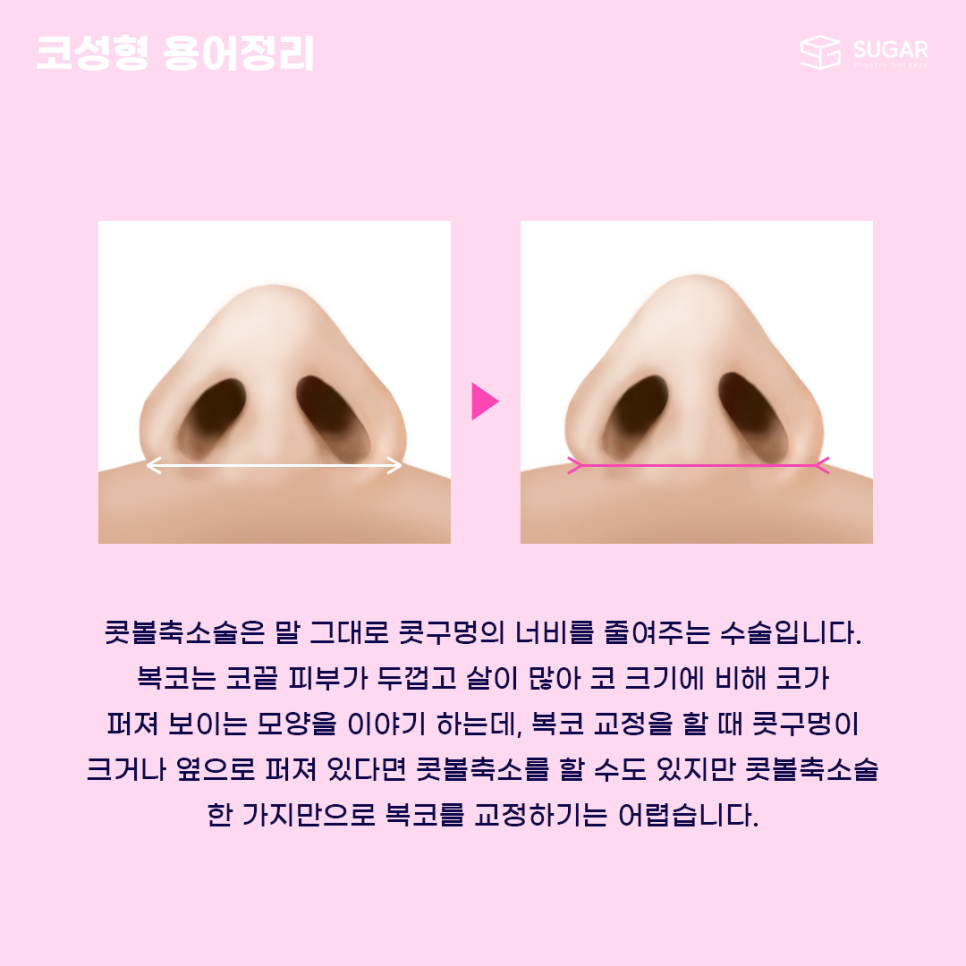 코성형 처음이라면? 용어정리! 관련 이미지 10