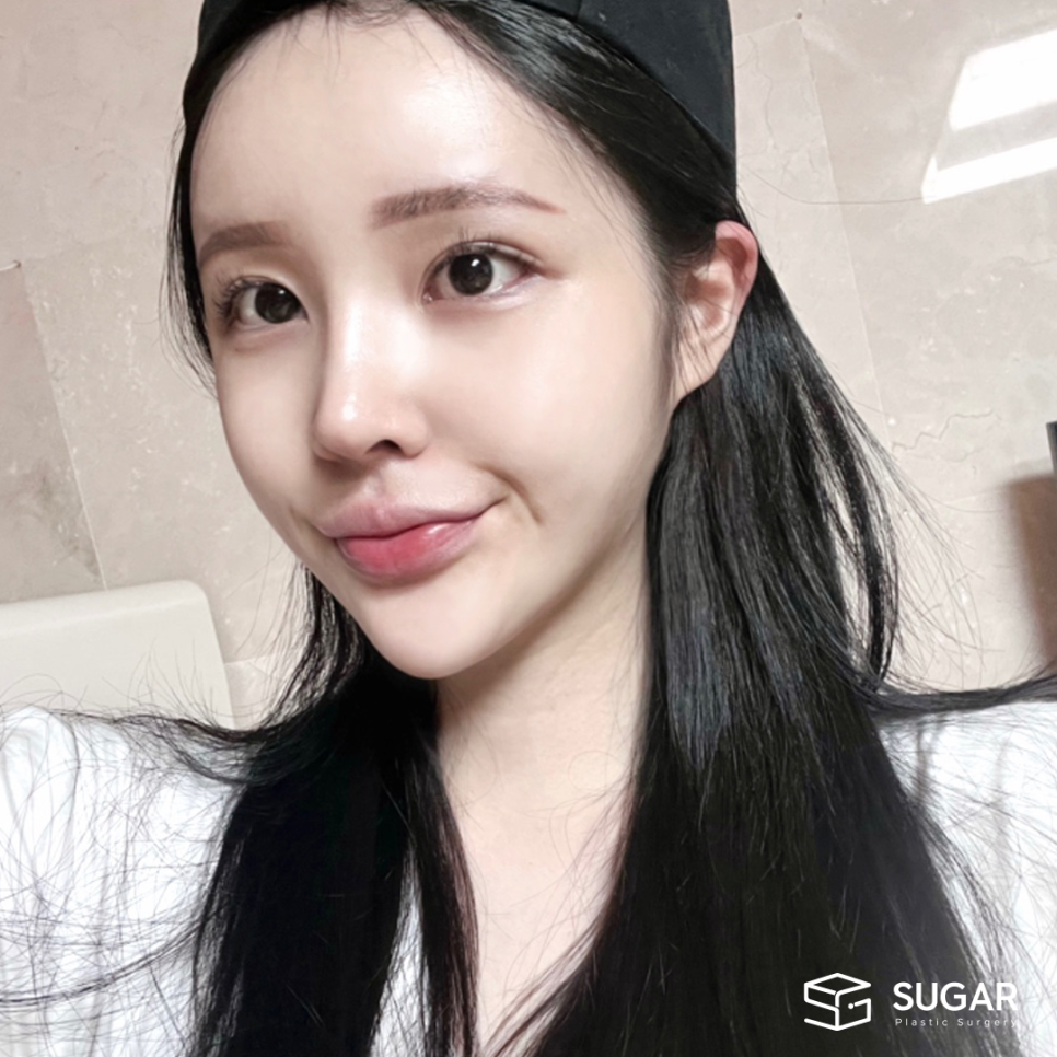 코성형 재료 다 알려드림 관련 이미지 13