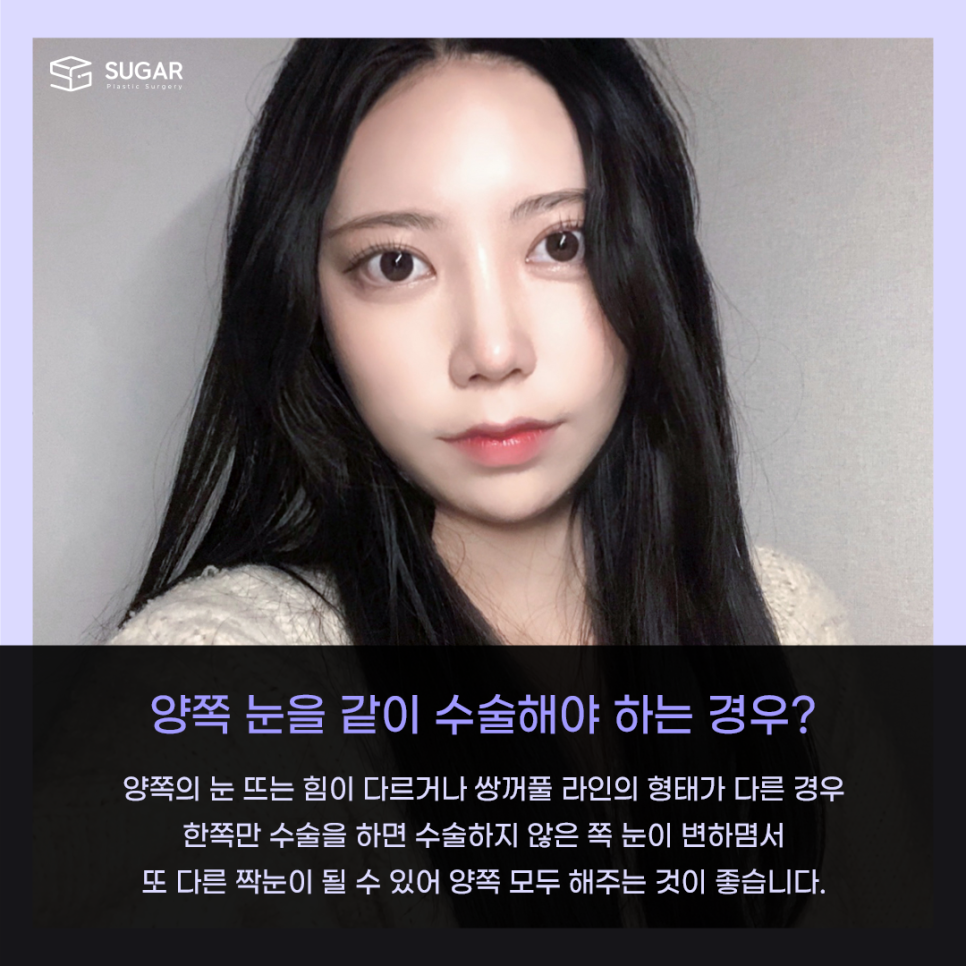 짝눈 교정 종류부터 해결까지 관련 이미지 8