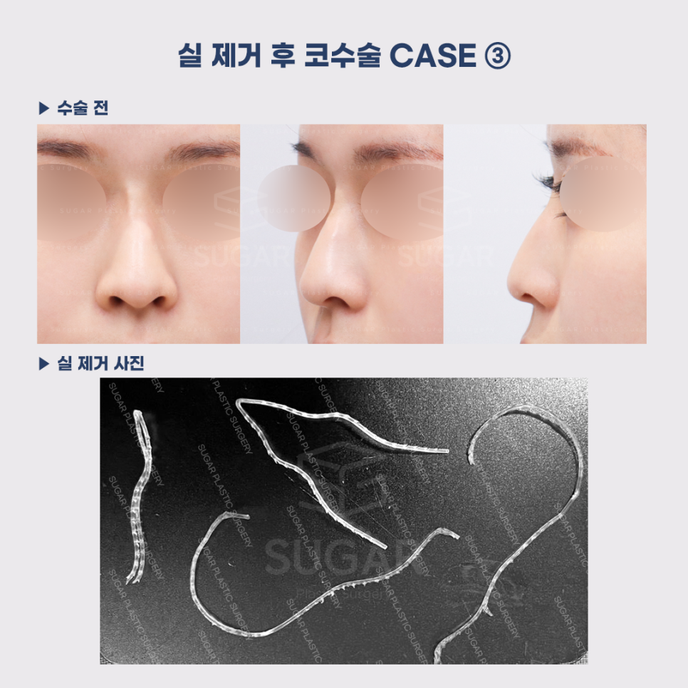 [슈가성형외과] 이런 코시술 하지마세요 관련 이미지 13