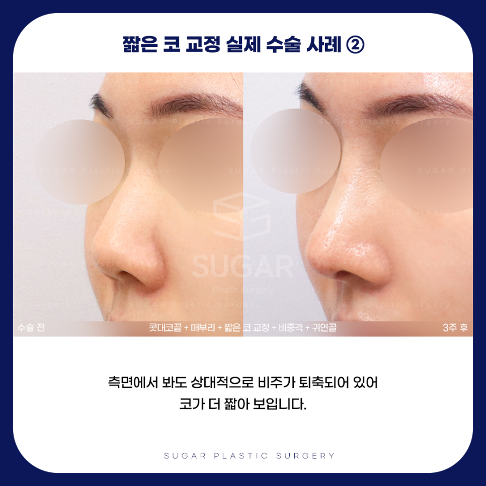 긴코 VS 짧은코 관련 이미지 16