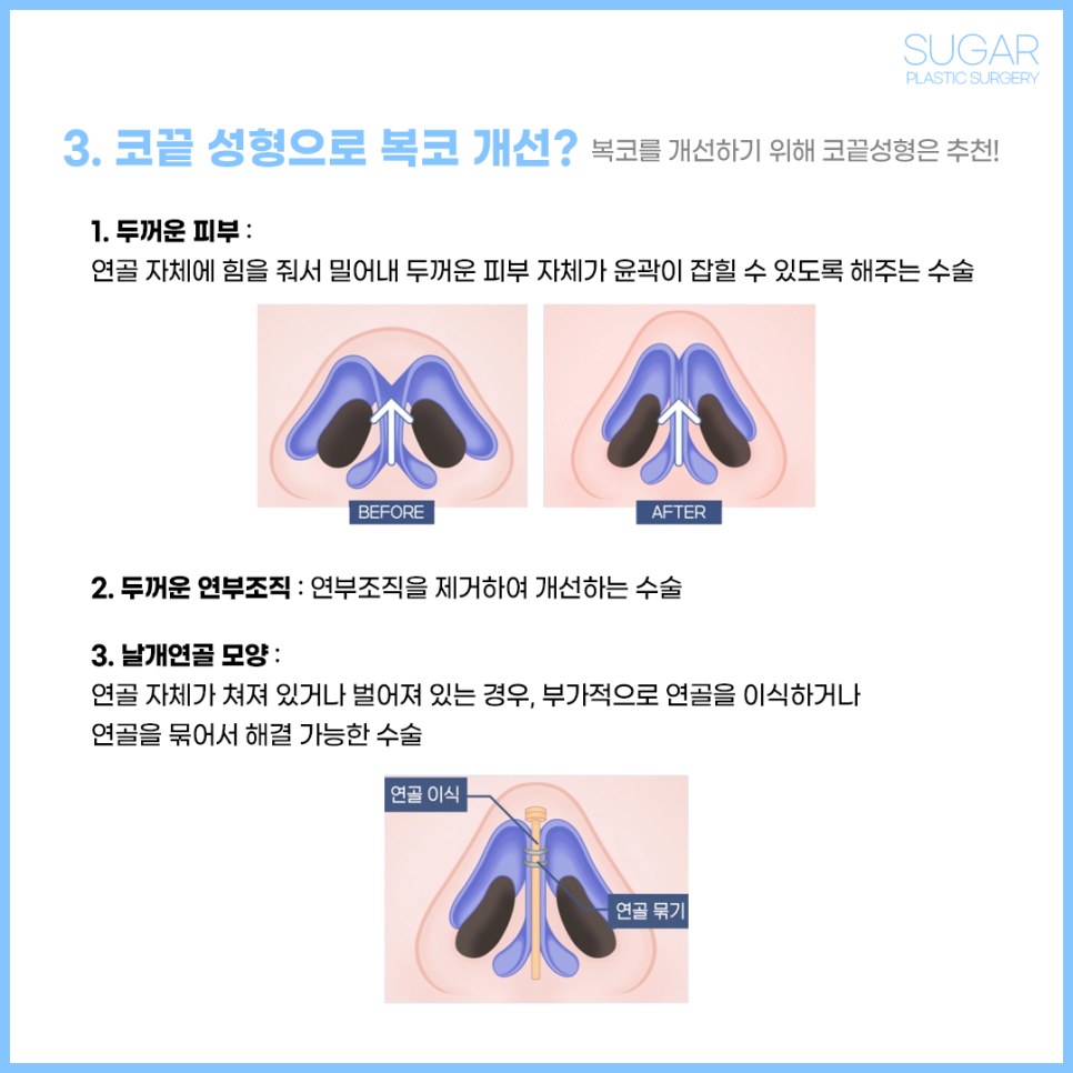 복코수술 유형에 따른 수술방법 관련 이미지 3