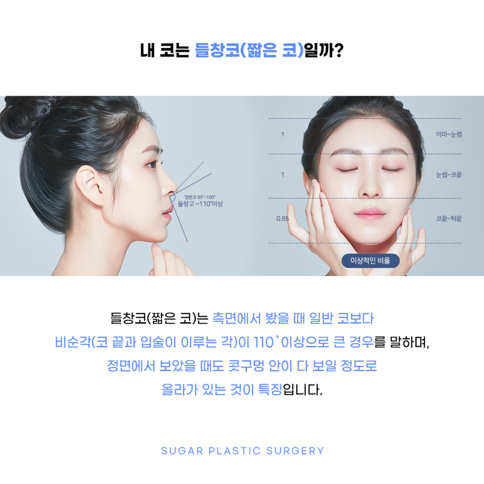 들창코 그 원인과 해결방법 관련 이미지 3
