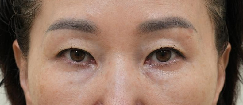 [눈성형] 나는 50대인데 무조건 하안검을 해야하나? 관련 이미지 1