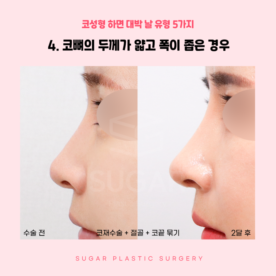 코성형 대박나는 코 관련 이미지 9