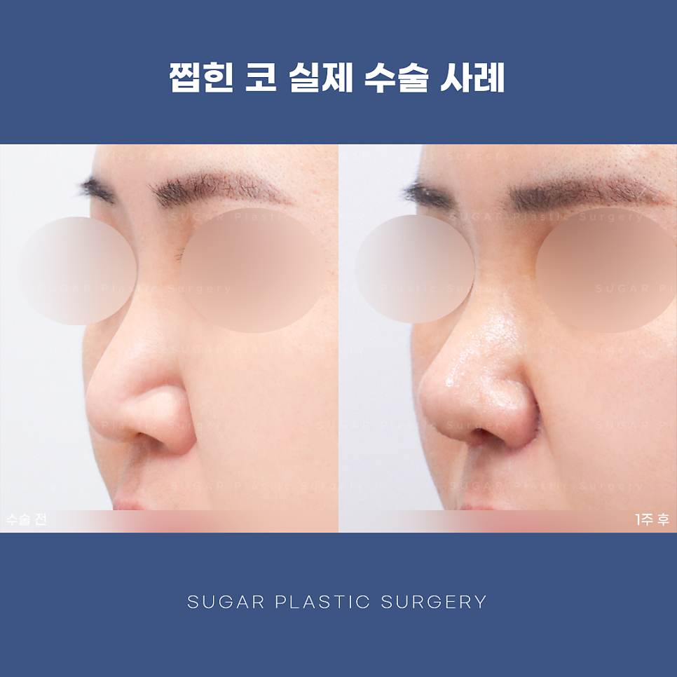찝힌코 왜 생기는 걸까? 관련 이미지 12