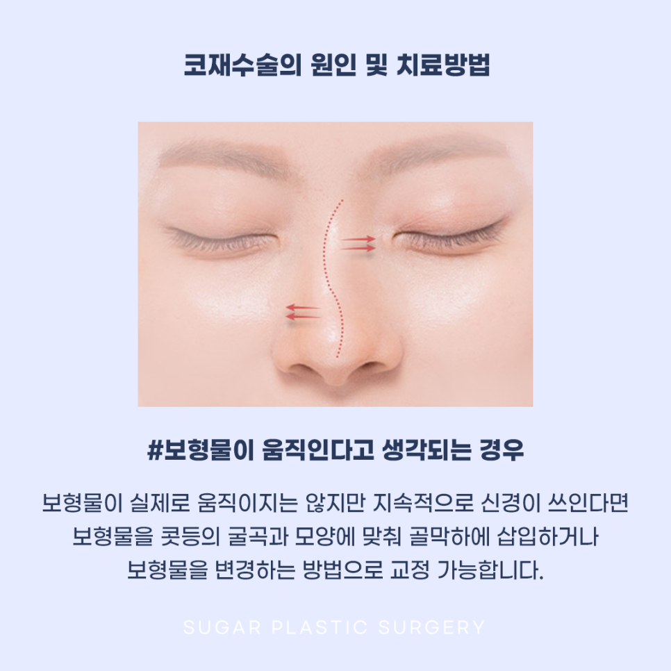 코재수술 그 유형과 해결방법은? 관련 이미지 10