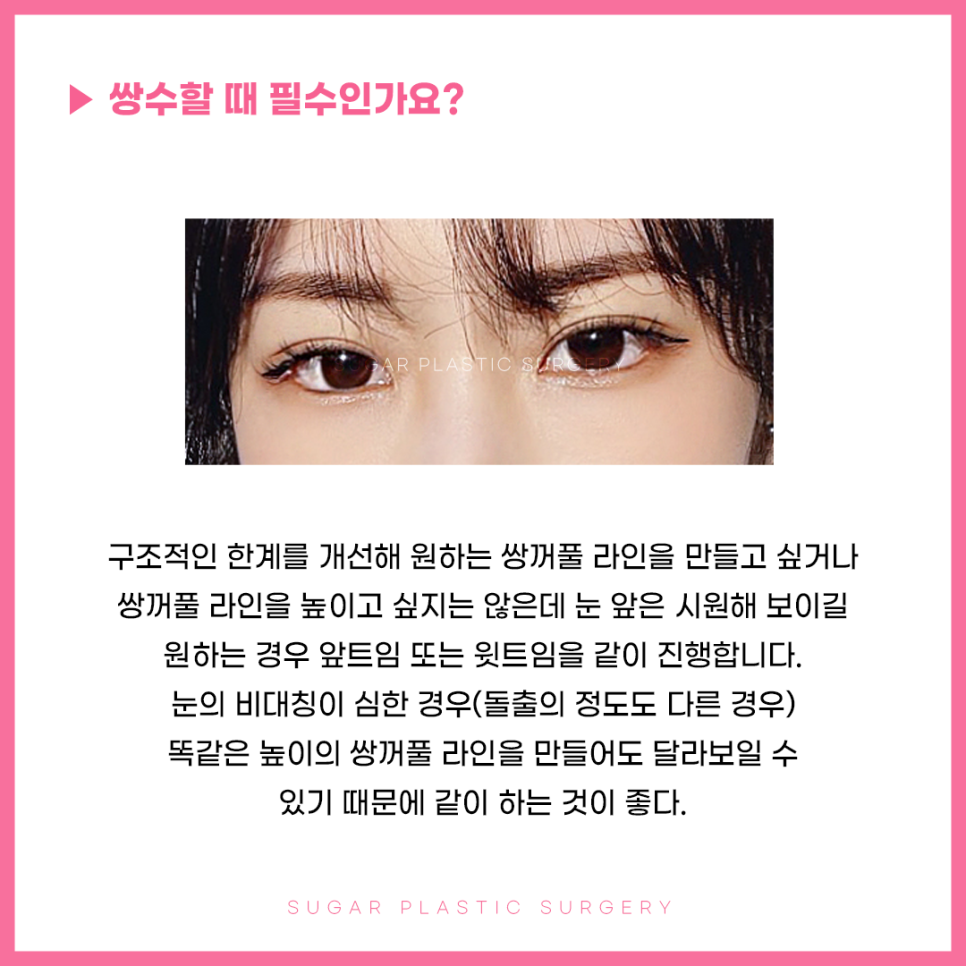 앞윗트임 어디까지 알아봤나요? 관련 이미지 4