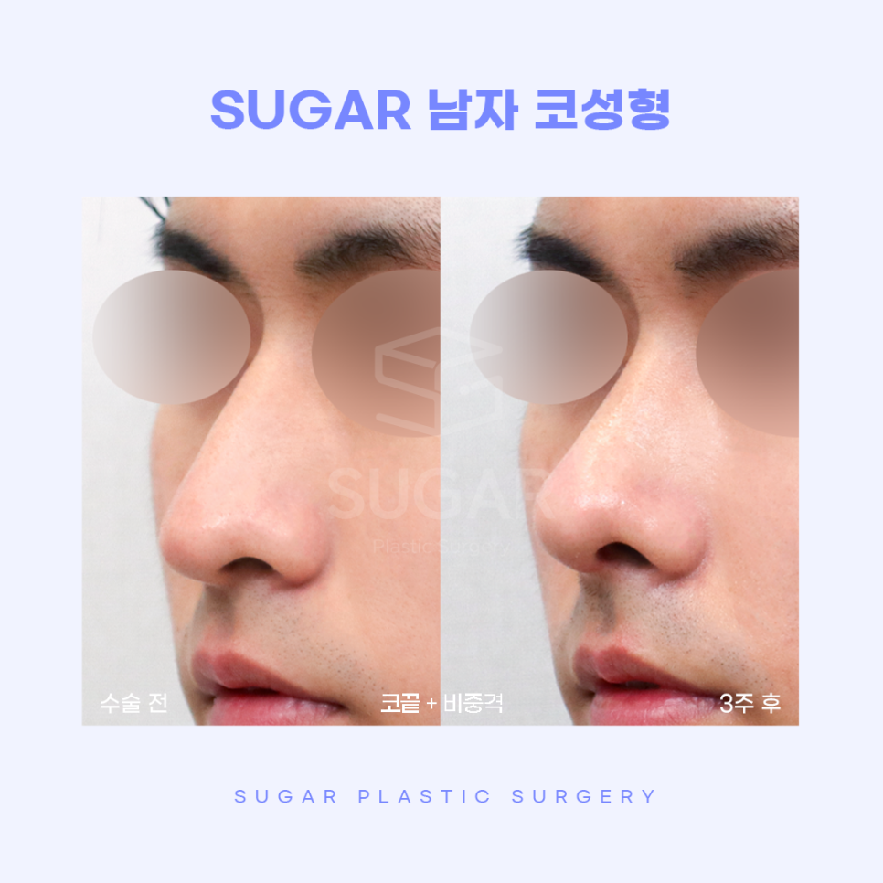 남자성형 대박나는 조건 관련 이미지 12