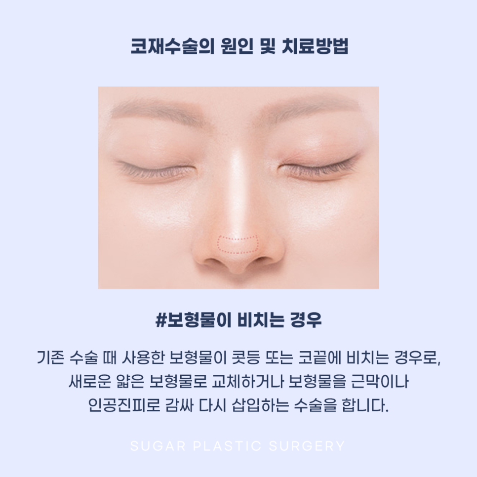 코재수술 그 유형과 해결방법은? 관련 이미지 9