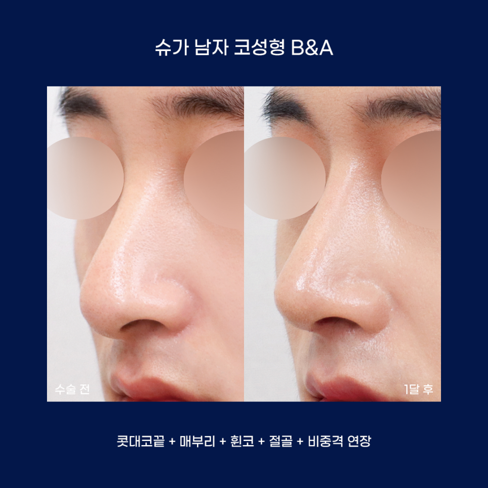 남자성형에 관한 궁금한 점 다 알려드립니다! 관련 이미지 15