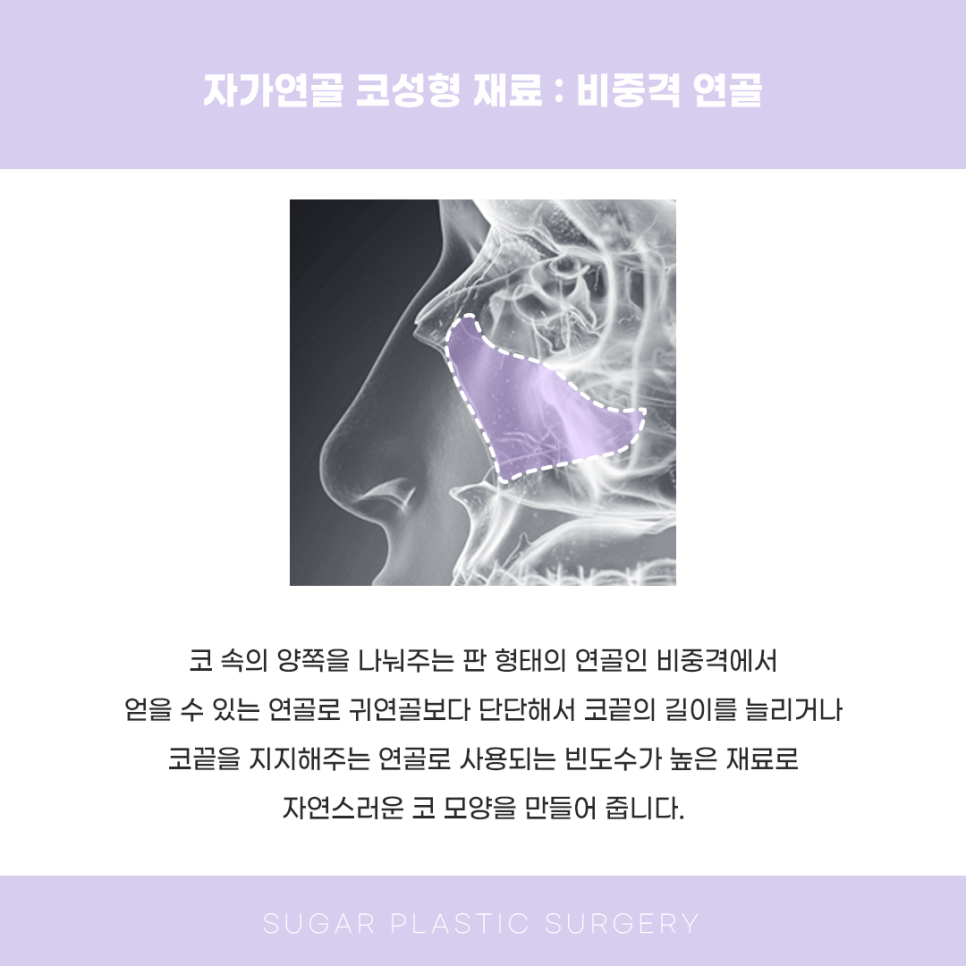코성형 재료 다 알려드림 관련 이미지 3