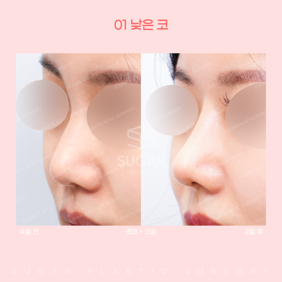 코 유형에 따른 코성형 방법 관련 이미지 3