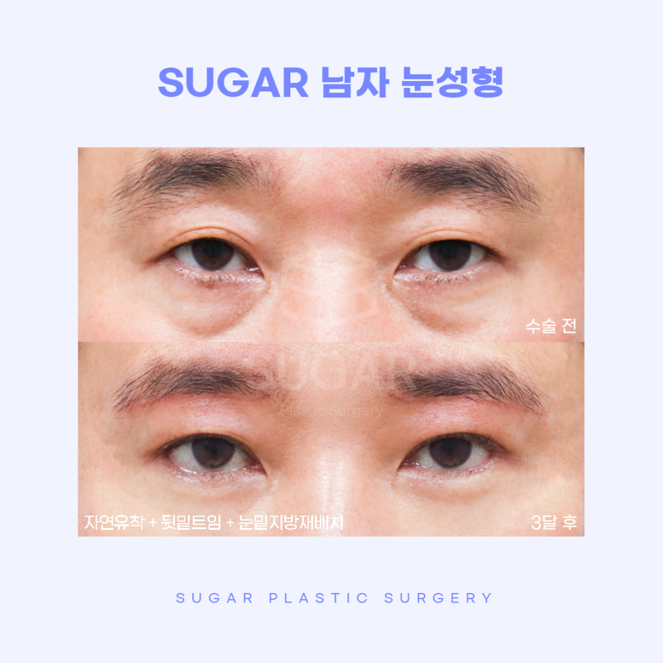 남자성형 대박나는 조건 관련 이미지 9