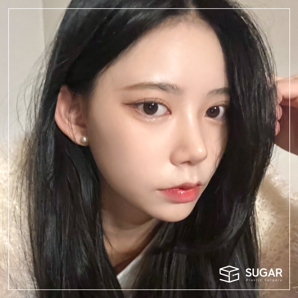 콧볼축소와 코끝성형을 같이 하는 이유는? 관련 이미지 5