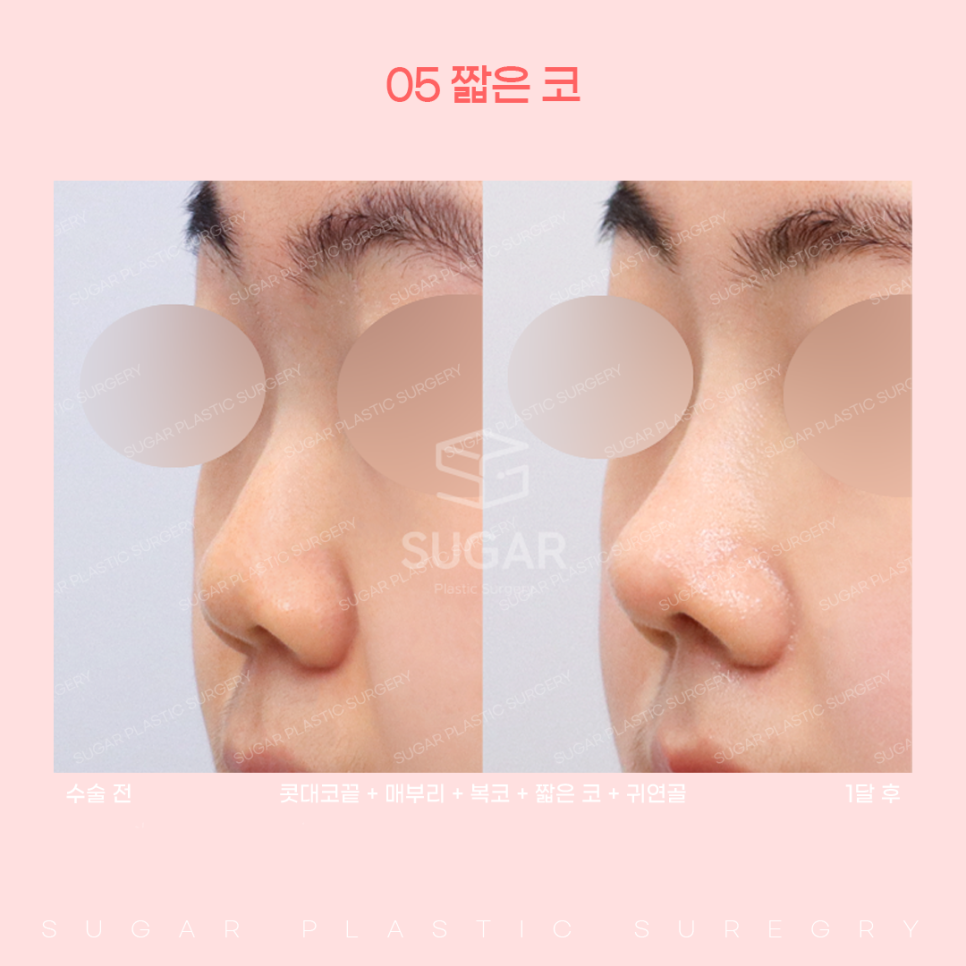 코 유형에 따른 코성형 방법 관련 이미지 17