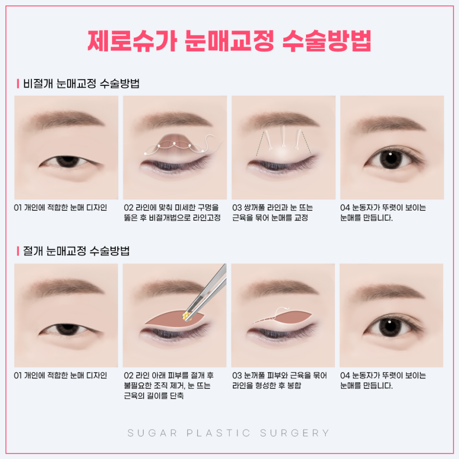 눈매교정 꼭 해야할까? 관련 이미지 4