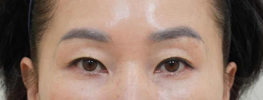 [눈성형] 나는 50대인데 무조건 하안검을 해야하나? 관련 이미지 2