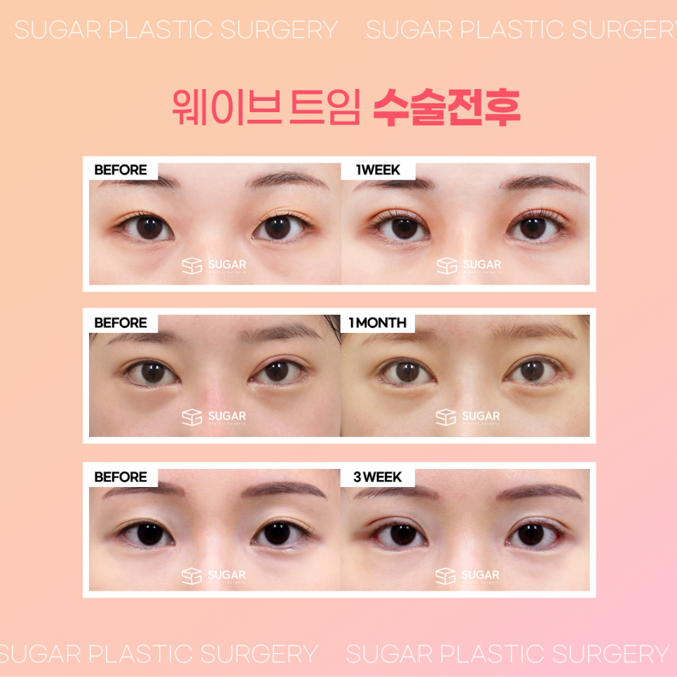 강남눈성형 뒤밑트임잘하는곳 2포인트로 확실하게 관련 이미지 8