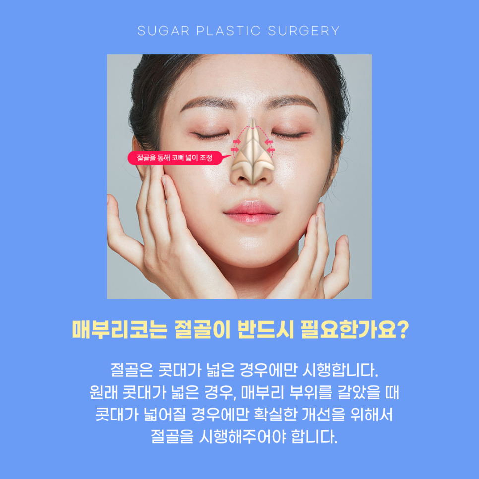 매부리코수술 매끄러운 라인으로 관련 이미지 5