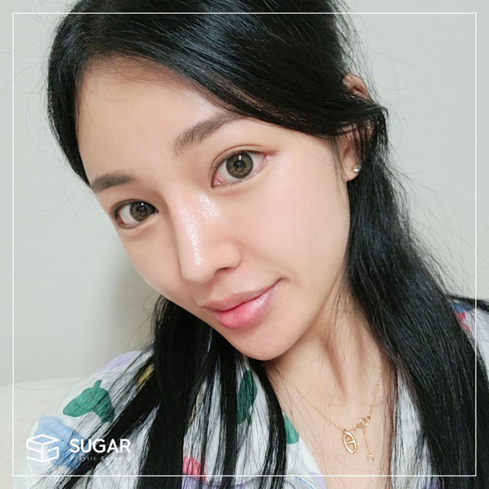 눈재수술 비절개로 가능할까? 관련 이미지 3