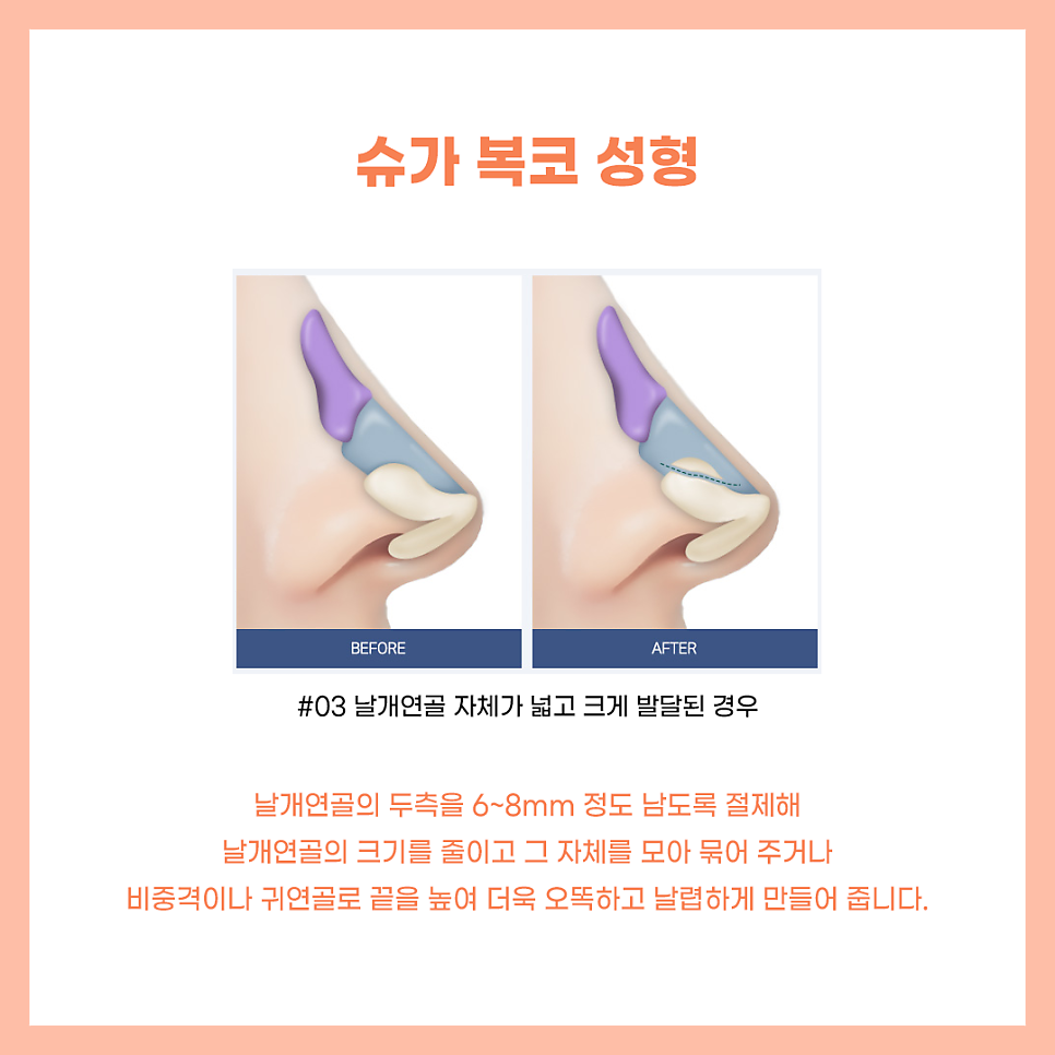코수술잘하는곳 알아보고 있다면? 관련 이미지 9