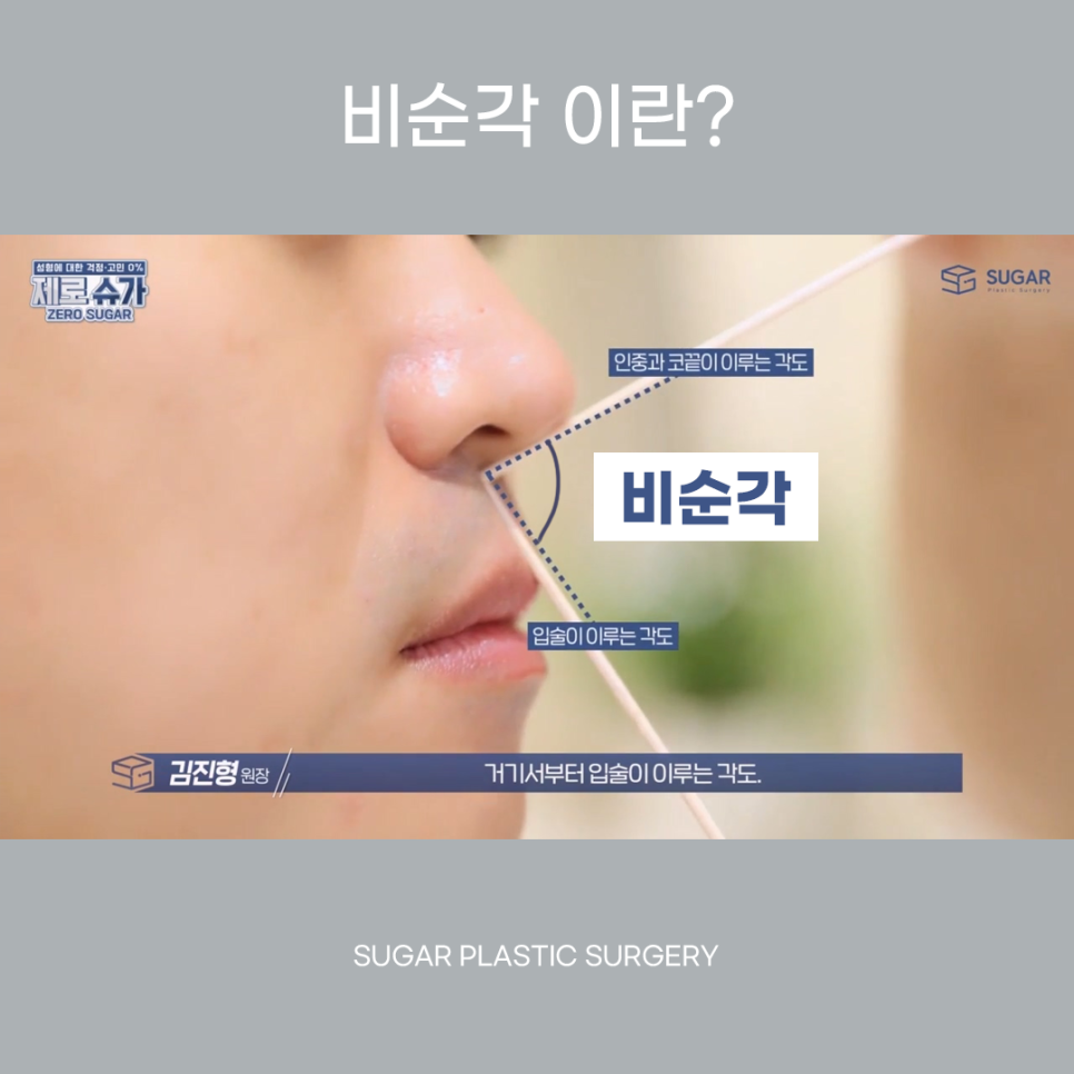 비주와 비순각교정 어떻게 할까? 관련 이미지 6