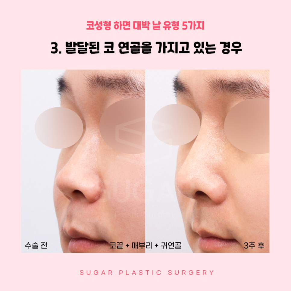 코성형 대박나는 코 관련 이미지 6