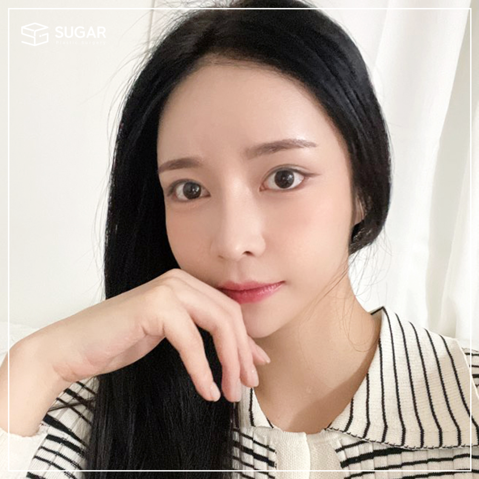 [슈가성형외과] 눈성형 실패하는 이유! 관련 이미지 3