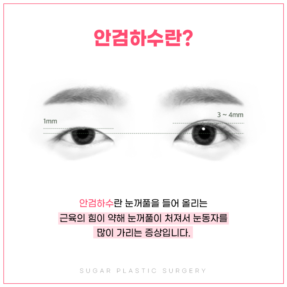 눈매교정 꼭 해야할까? 관련 이미지 2