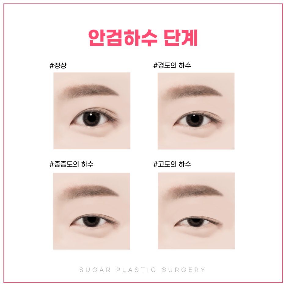 눈매교정 꼭 해야할까? 관련 이미지 3
