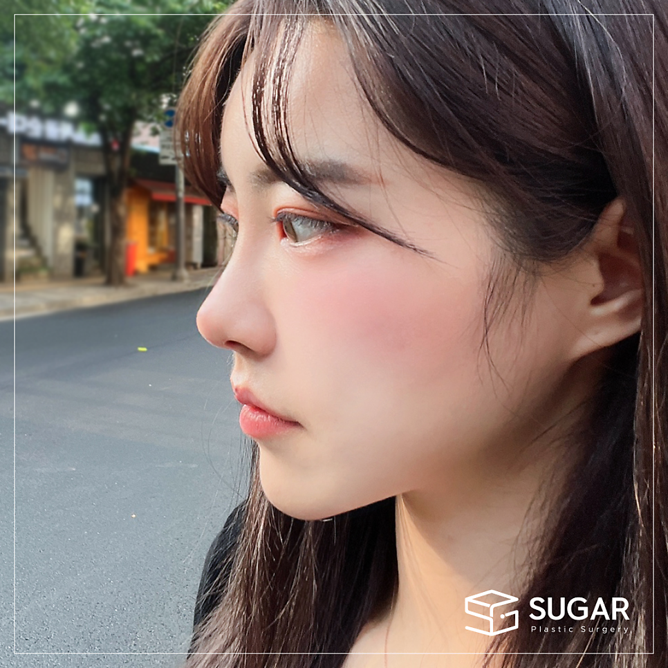 비주와 비순각교정 어떻게 할까? 관련 이미지 12