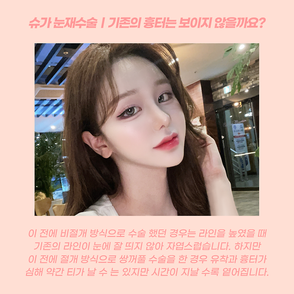 눈재수술 라인높이는 방법 관련 이미지 5