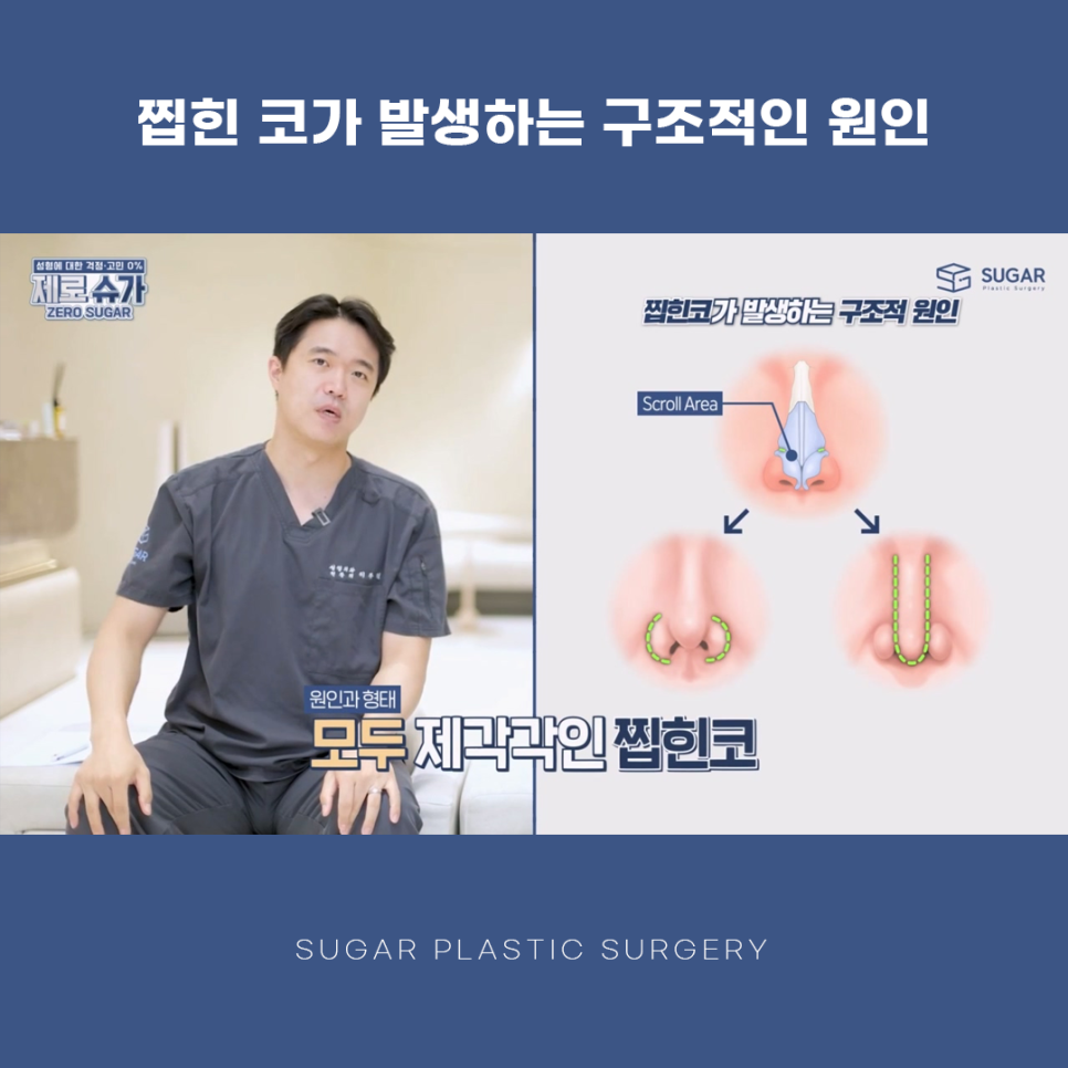 찝힌코 왜 생기는 걸까? 관련 이미지 3