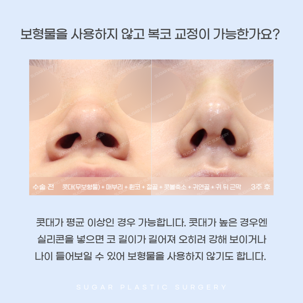 콧볼축소와 코끝성형을 같이 하는 이유는? 관련 이미지 7