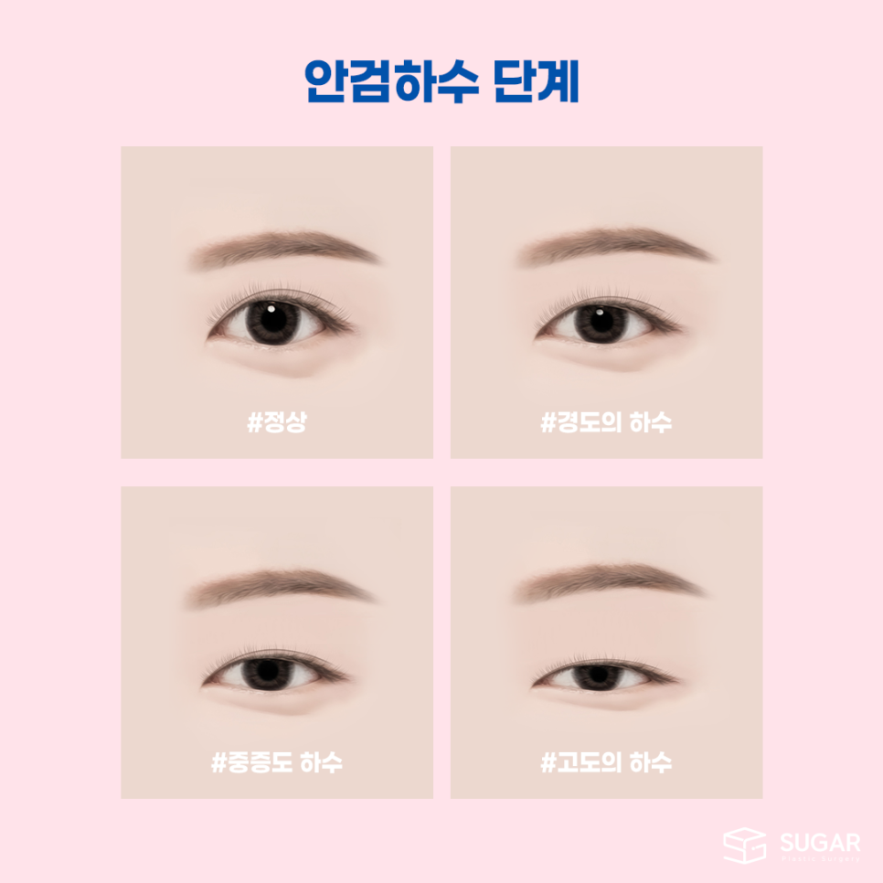비절개눈매교정 VS 절개눈매교정 관련 이미지 3