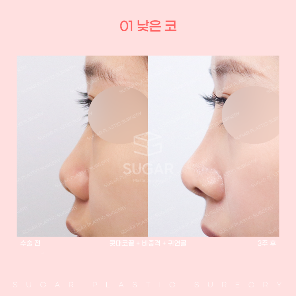 코 유형에 따른 코성형 방법 관련 이미지 6