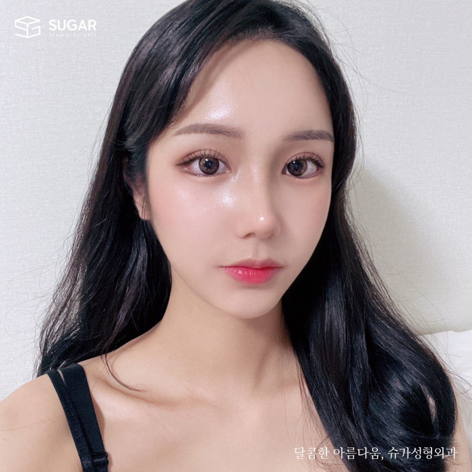 눈밑지방재배치 그 방법과 효과 관련 이미지 4