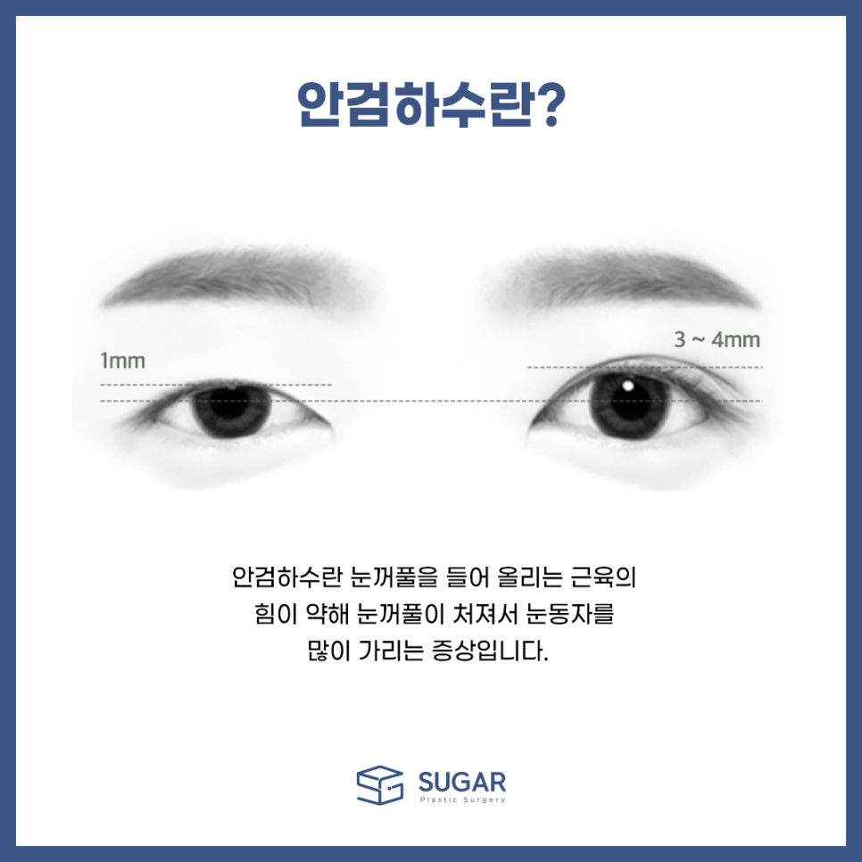 남자눈성형 뭐가 다를까? 관련 이미지 4