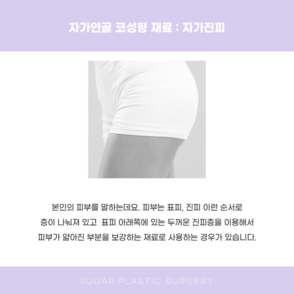 코성형 재료 다 알려드림 관련 이미지 5